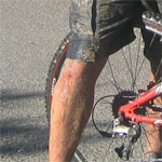 manly dam knee injury